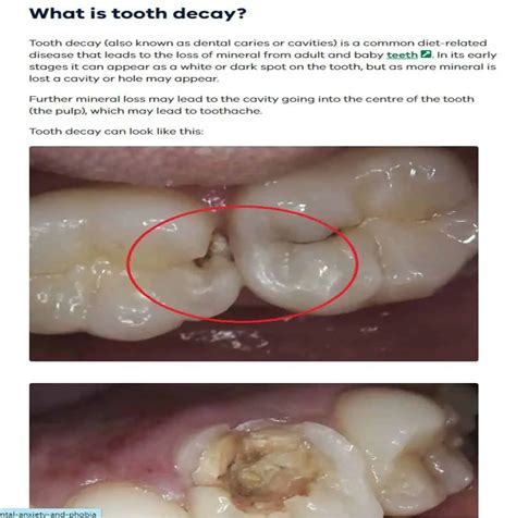 Tooth Decay | Oral Health | Healthy Mouth | Growing Smiles