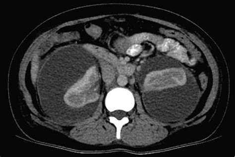 双侧肾周包膜下大量积液：超声 CT及治疗 - 丁香园