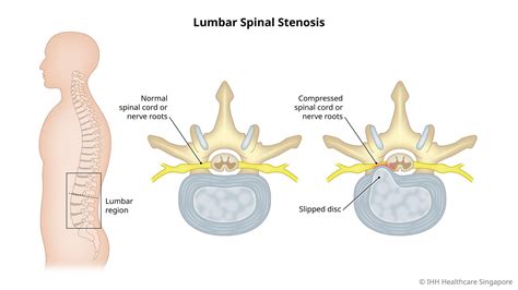 Lumbar Spinal Stenosis - Symptoms & Causes | Gleneagles Hospital