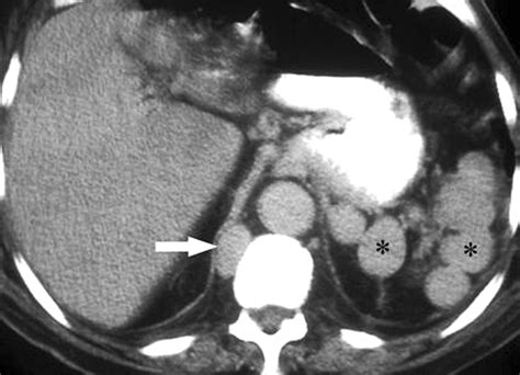 The Diaphragmatic Crura and Retrocrural Space: Normal Imaging ...