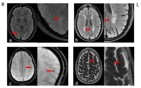 Zerebrale Mikroembolisignale : Embolie-Erkennung, HITS-Erkennung mit TCD-Überwachung – JJFEH
