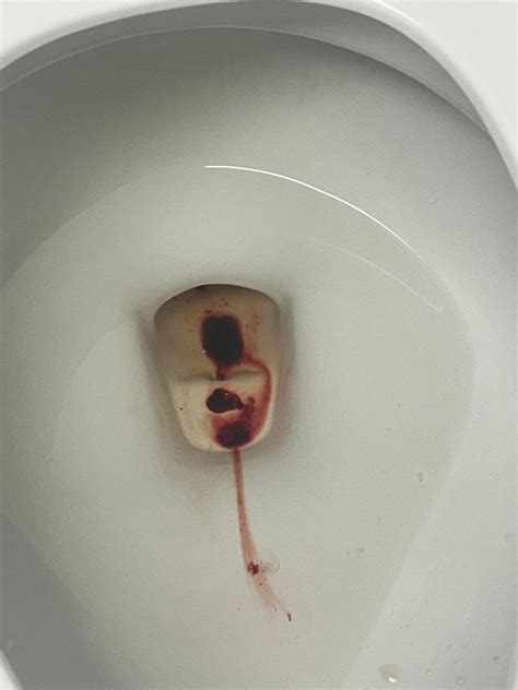 Implantation bleeding or miscarriage | BabyCentre