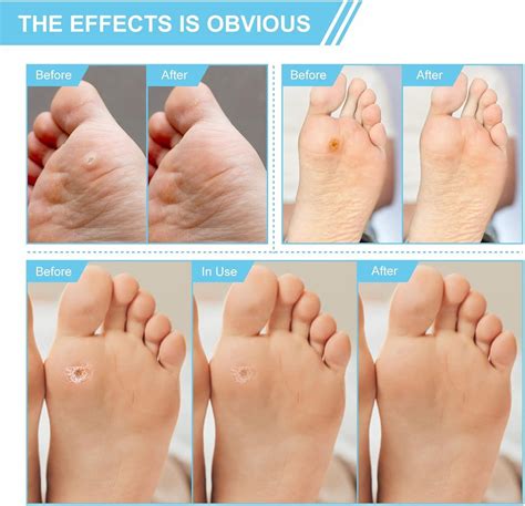 Wart Remover Plasters for Hands & Feet - Corn & Verruca Removal - Plantar Warts & Callus ...