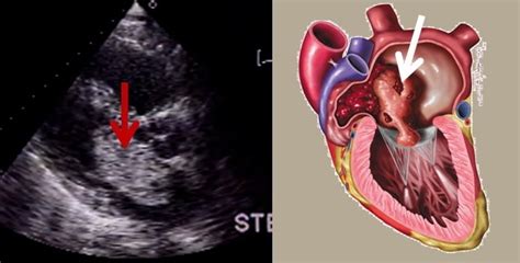 Image result for International Classification of Functioning Stroke