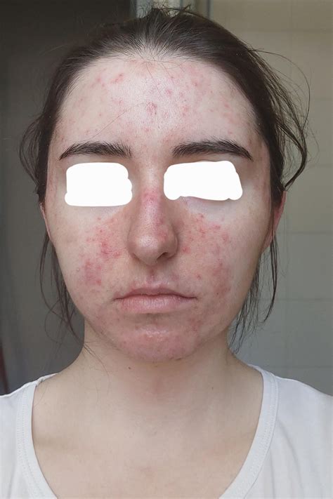 Redness and bumps (not acne) in the center of my face + acne on the sides (more info in comments ...