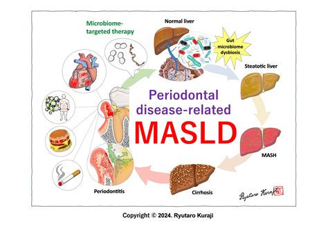 Potential disease definition of periodontal disease-related-MASLD/MASH and microbiome-targeted ...