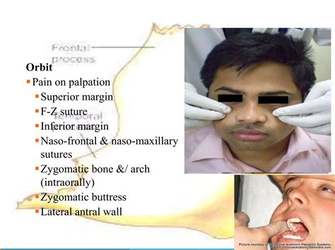 Management of zygomaticomaxillary complex fractures ih | PPTX