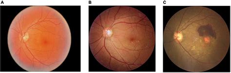 Frontiers | Classification of dry and wet macular degeneration based on the ConvNeXT model