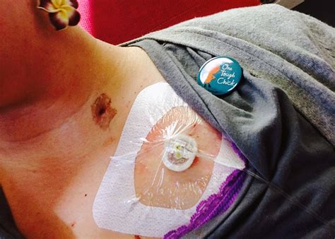 Port Placement For Chemo