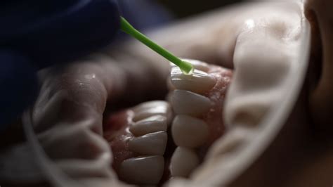 Image result for Tooth Stain