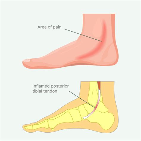 Tibialis Anterior Foot Pain