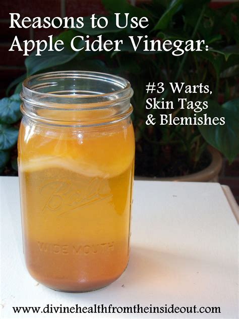 Apple Cider Vinegar Warts Black Dots at Carlos Miguel blog