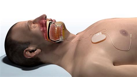 FDA Approves Implanted Device for Sleep Apnea | Sleep Review