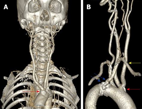 Subclavian Artery Stenosis