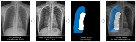 Quantitative Measurement of Pneumothorax Using Artificial Intelligence ...