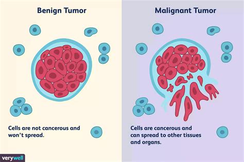 Benign tümör Nedir? • Doktordan Haberler