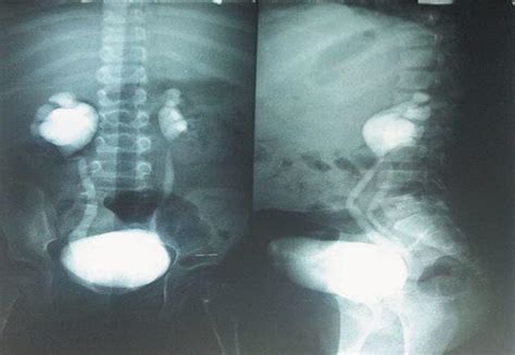 INTRAVENOUS UROGRAPHY