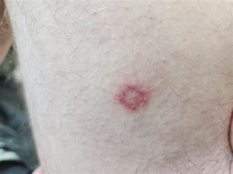 About day 5. Inner thigh, dime sized. Itches. Wth bit me? TIA : r/bugbites