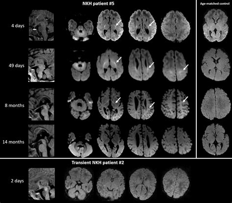 Brain imaging in classic nonketotic hyperglycinemia: Quantitative ...