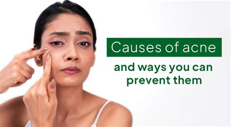 What is the main reason for acne and how to prevent acne naturally ...