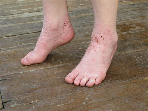Itchy Rash on Top of Foot: Causes and Treatments | New Health Advisor