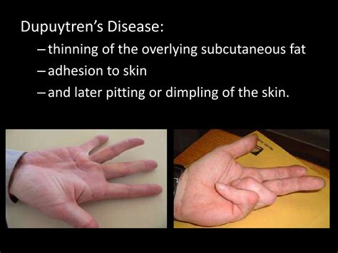dupuytrens contracture and its intervention | PPTX