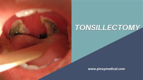 Tonsillectomy Surgery Price in the Philippines 2026 — PinoyMedical