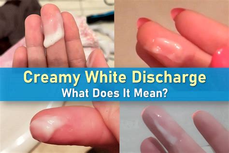Creamy White Discharge: What Does It Mean