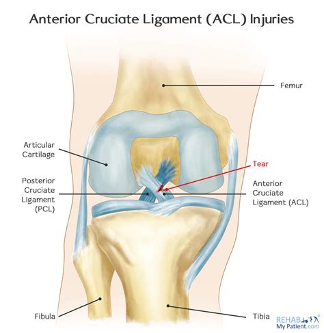 Anterior Cruciate Ligament Tear