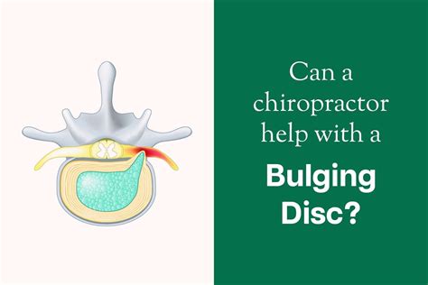 Can a Chiropractor Help with a Bulging Disc? • Copa Chiropractic Wales