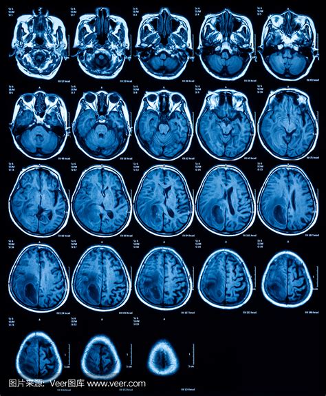 脑部核磁共振检查什么脑部核磁共振检查什么病2022已更新今日推荐