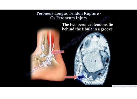 Peroneus Longus Tendon Injury-Os Peroneum — OrthopaedicPrinciples.com