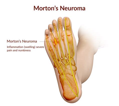 Morton's Neuroma — Matrix Foot and Ankle