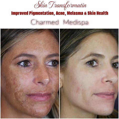 Skin Damage, Acne, Pigmentation And Skin Health ZO Skin Health Solutions – Charmed Medispa