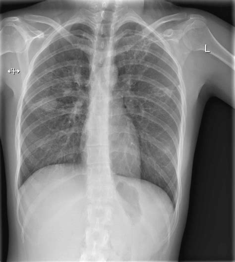 How To Identify Tb In X Ray at Carly Decosta blog