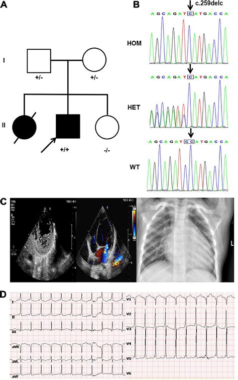 Frontiers | A novel loss-of-function mutation in NRAP is associated with left ventricular non ...