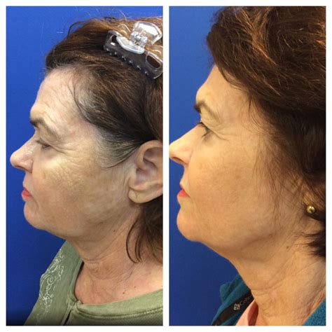 Fractional Laser Scar Treatment Services | Skin Resurfacing