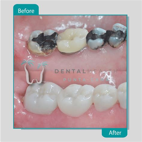 Dental Crown Material Types at Ruby Lay blog