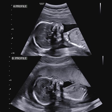Anatomy Scan At 23 Weeks 16 Week Anomaly Scan EARLY DIAGNOSIS Of
