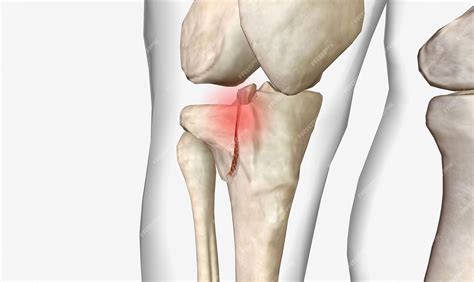 Proximal Tibia 的图像结果