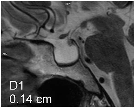The Influence of Pituitary Morphology on the Occurrence of Hormonal ...