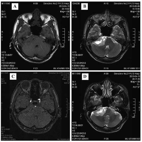 Bruns nystagmus in cerebellopontine angle tumor