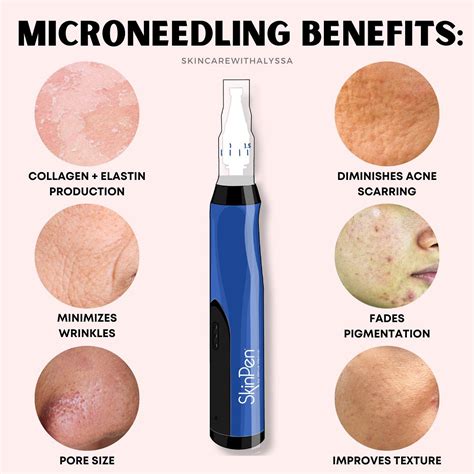 Alyssa Ryan | Aesthetician on Instagram: "Microneedling has so many benefits for your skin ...