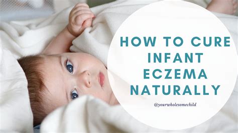 How to Cure Infant Eczema Naturally - Your Wholesome Child
