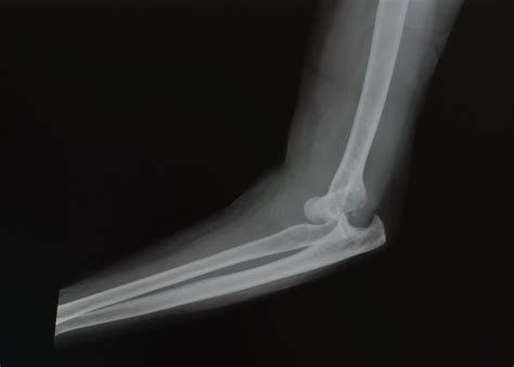 Elbow Dislocation