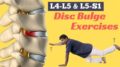 Image result for L5 Bulging Disc Exercises