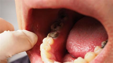 Tooth Socket After Extraction 的图像结果