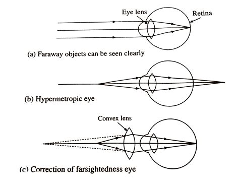 What is hypermetropia or farsightedness ? What are the possible reasons ...