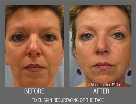 Tixel ® Skin Resurfacing