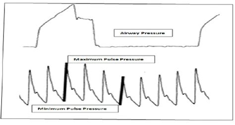 Image result for Pulse Pressure Variation Explained